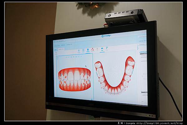 【彰化牙齒矯正推薦】Invisalign 隱適美隱形牙套 陳長泰牙醫診所