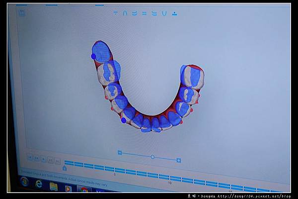【彰化牙齒矯正推薦】Invisalign 隱適美隱形牙套 陳長泰牙醫診所
