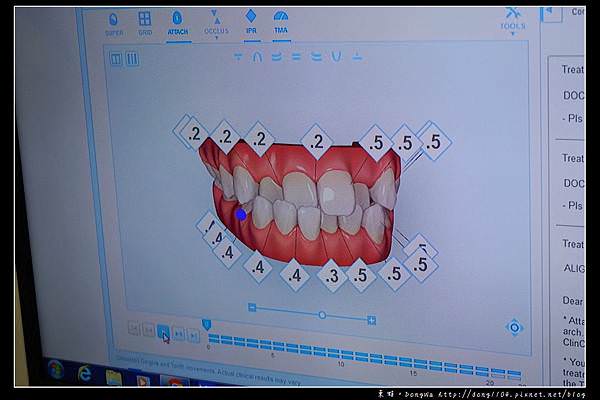 【彰化牙齒矯正推薦】Invisalign 隱適美隱形牙套 陳長泰牙醫診所
