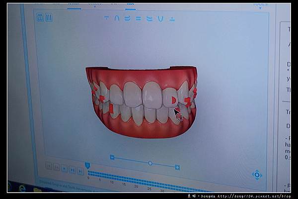 【彰化牙齒矯正推薦】Invisalign 隱適美隱形牙套 陳長泰牙醫診所