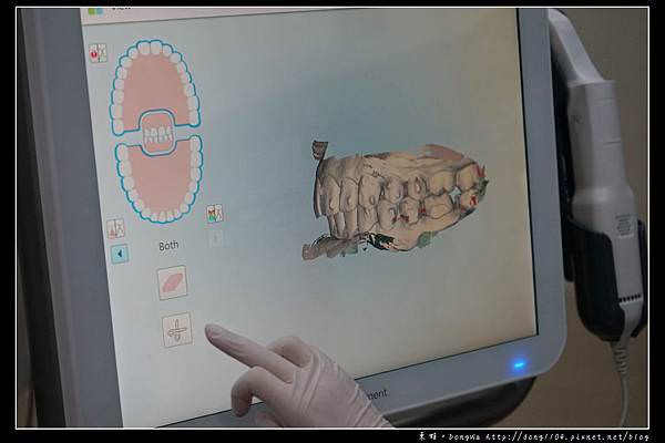 【彰化牙齒矯正推薦】Invisalign 隱適美隱形牙套 陳長泰牙醫診所
