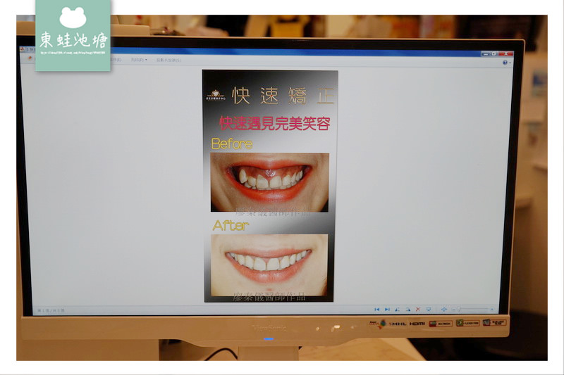【新竹快速矯正推薦】竹北真美牙醫診所 美容矯正術前評估 晶鑽全瓷微笑設計