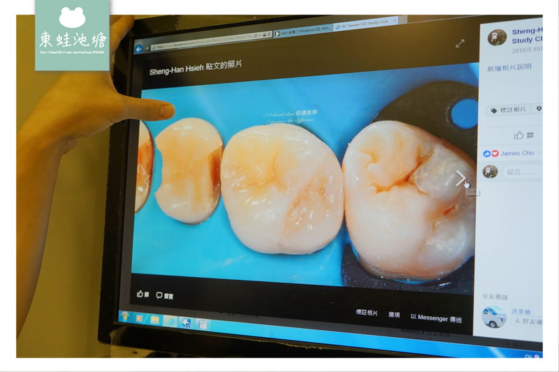 【頂尖陶瓷嵌體技術】如拼圖般補上牙齒的缺損處 依德牙科美學中心 