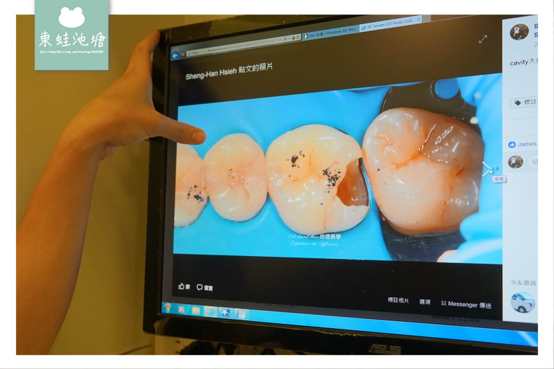 【頂尖陶瓷嵌體技術】如拼圖般補上牙齒的缺損處 依德牙科美學中心 