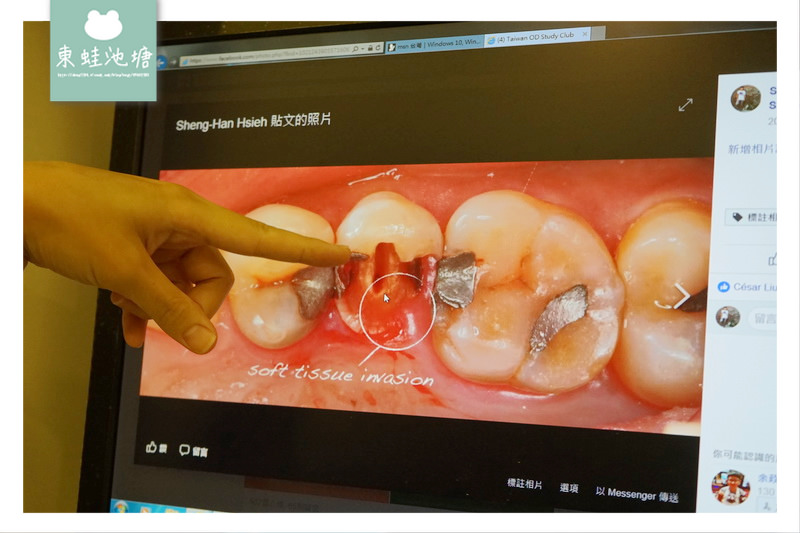 【頂尖陶瓷嵌體技術】如拼圖般補上牙齒的缺損處 依德牙科美學中心 