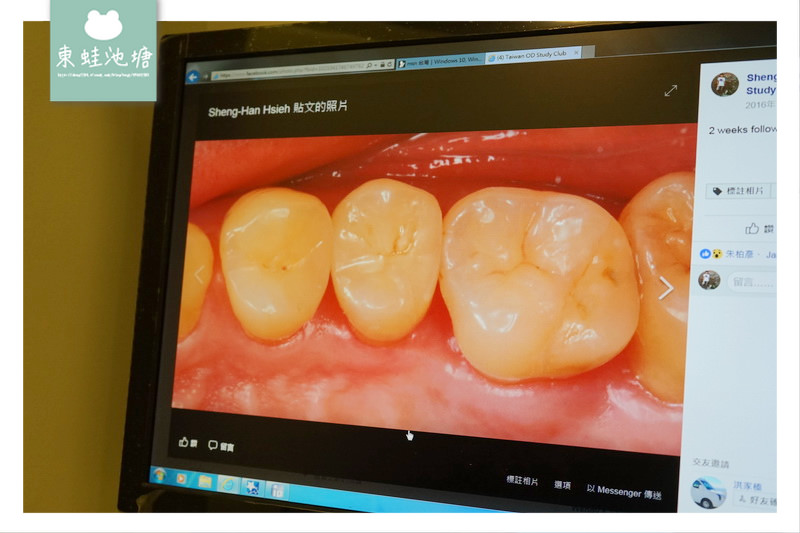 【頂尖陶瓷嵌體技術】如拼圖般補上牙齒的缺損處 依德牙科美學中心 