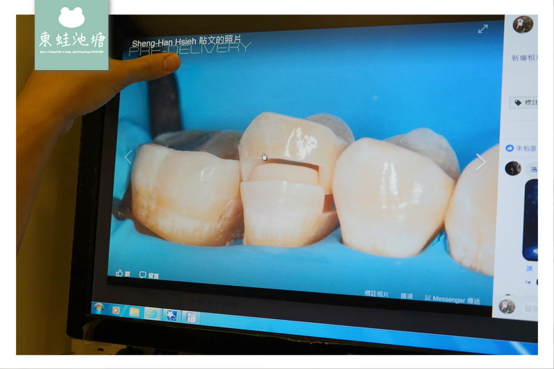 【頂尖陶瓷嵌體技術】如拼圖般補上牙齒的缺損處 依德牙科美學中心 