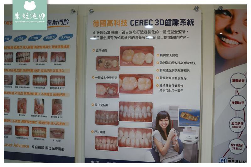 【竹北全瓷冠貼片推薦】全瓷牙冠術前評估 取模咬蠟流程介紹 竹北真美牙醫診所