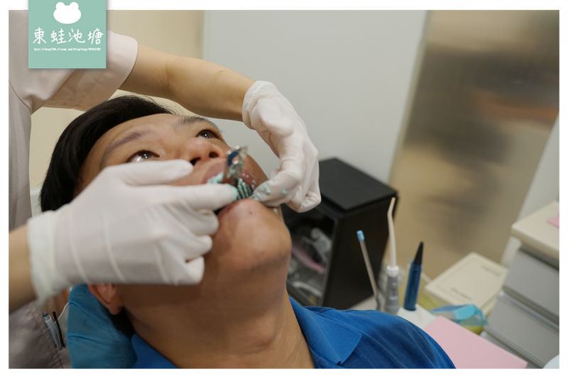【竹北全瓷冠貼片推薦】全瓷牙冠術前評估 取模咬蠟流程介紹 竹北真美牙醫診所