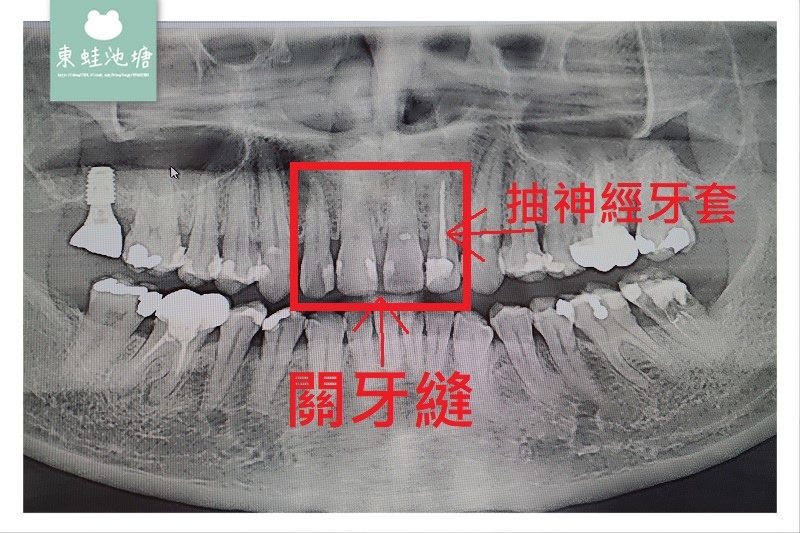 【竹北一日3D齒雕全瓷冠心得分享】真美舒眠植牙中心 關牙縫抽神經保護牙套美容最佳選擇