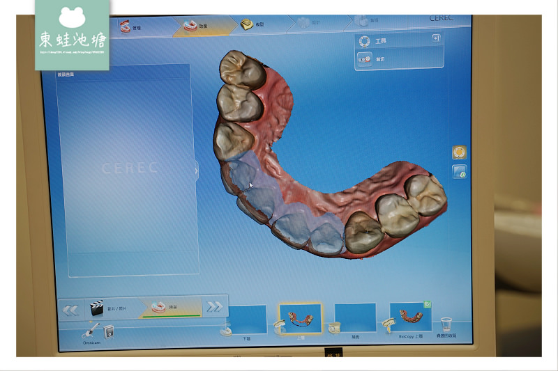 【竹北一日3D齒雕全瓷冠心得分享】真美舒眠植牙中心 關牙縫抽神經保護牙套美容最佳選擇