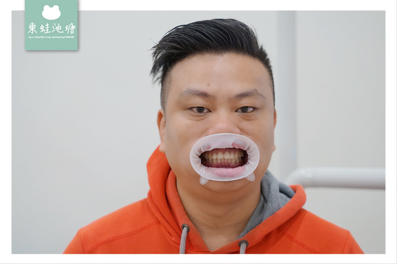 【竹北一日3D齒雕全瓷冠心得分享】真美舒眠植牙中心 關牙縫抽神經保護牙套美容最佳選擇