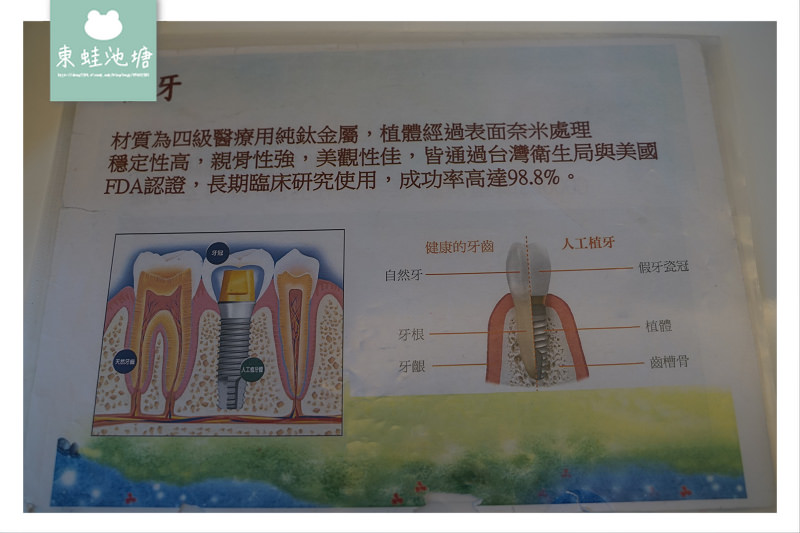 【桃園藝文特區牙醫診所推薦】拔牙與植牙心得分享 藝品牙醫診所