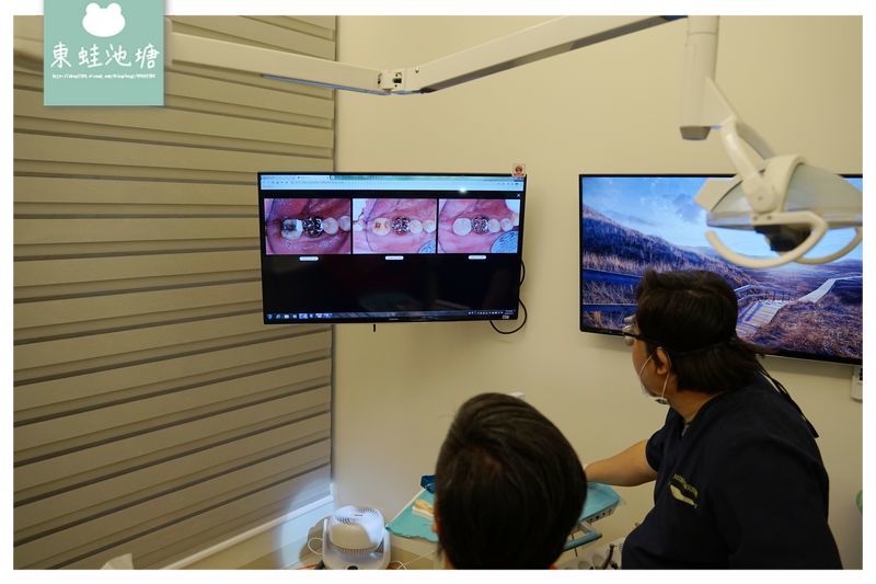 【新竹微創齒雕推薦】量身定做3D齒雕嵌體 告別樹脂與銀粉 日光翡麗牙醫診所