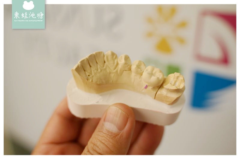【新竹微創齒雕推薦】量身定做3D齒雕嵌體 告別樹脂與銀粉 日光翡麗牙醫診所
