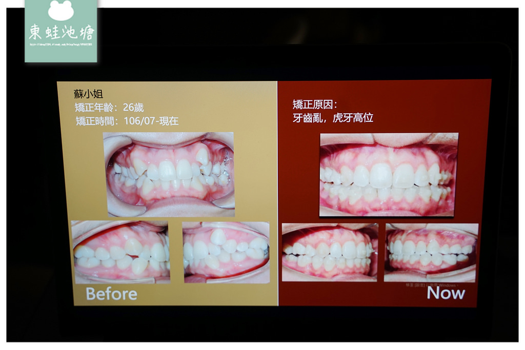 【台中隱形矯正推薦】齒顎矯正專科醫師 隱適美隱形矯正專家 上誠齒顎矯正中心