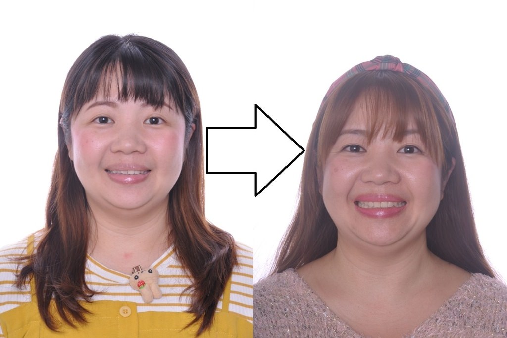 【康澤牙醫診所】歷時3年4個月隱適美隱形矯正全紀錄 隱形牙套優點特色大分享